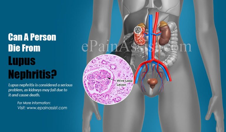 Can A Person Die From Lupus Nephritis?