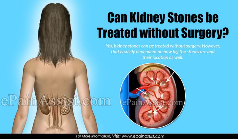 Can Kidney Stones Be Treated Without Surgery?