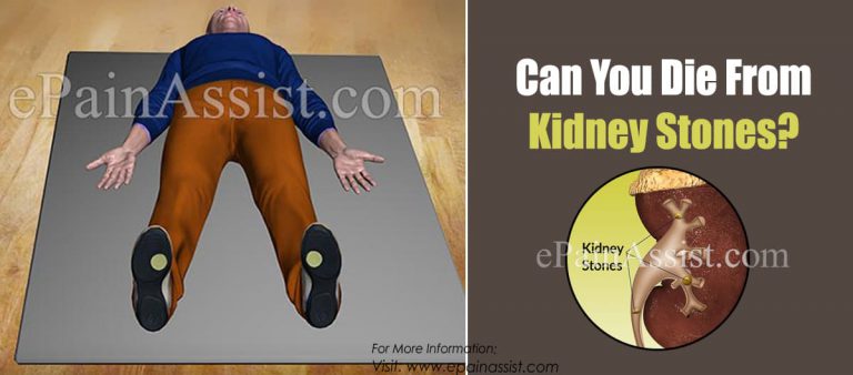 Can You Die From Kidney Stones?
