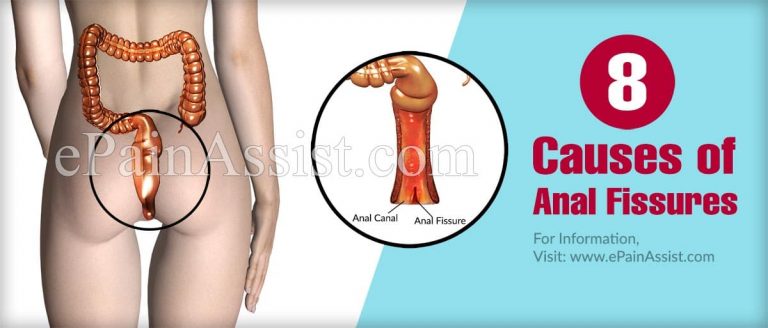7 Causes Of Anal Fissures