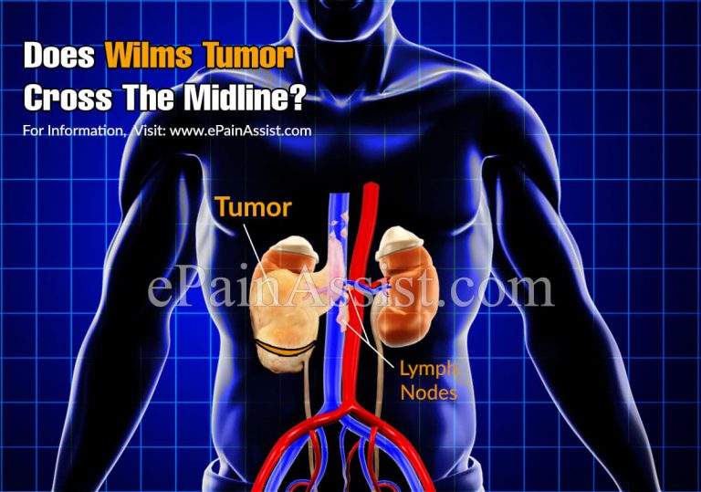Does Wilms Tumor Cross The Midline?