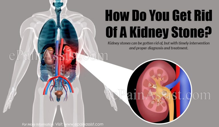How Do You Get Rid Of A Kidney Stone?