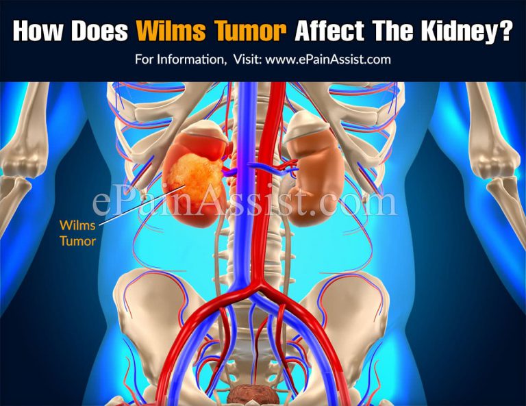 How Does Wilms Tumor Affect The Kidney?