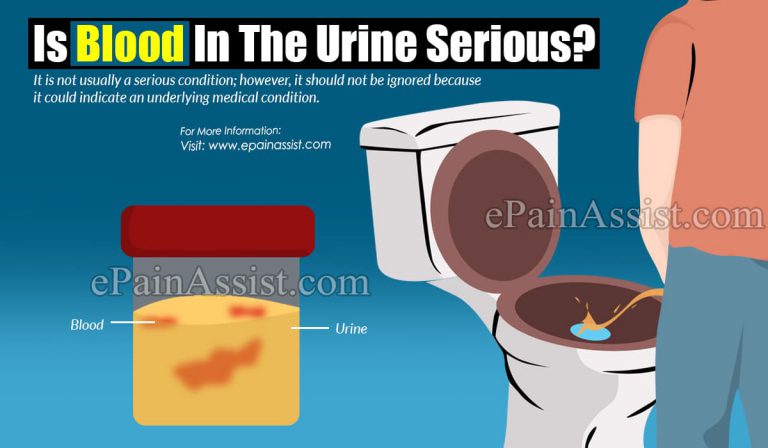 Is Blood In The Urine Serious?