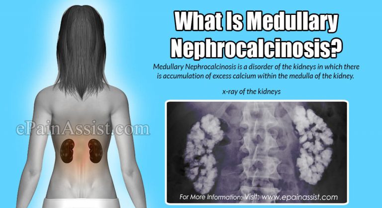 Medullary Nephrocalcinosis: Causes, Symptoms, Treatment