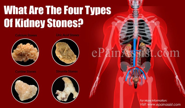 What Are The Four Types Of Kidney Stones?