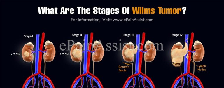 What Are The Stages Of Wilms Tumor & What Is The Survival Rate?