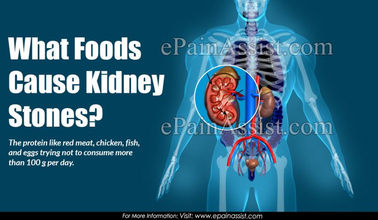 What Foods Cause Kidney Stones?