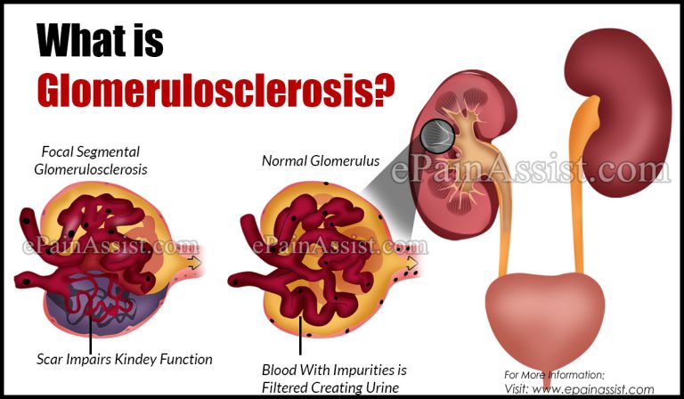 Glomerulosclerosis: Causes, Symptoms, Treatment, Diagnosis