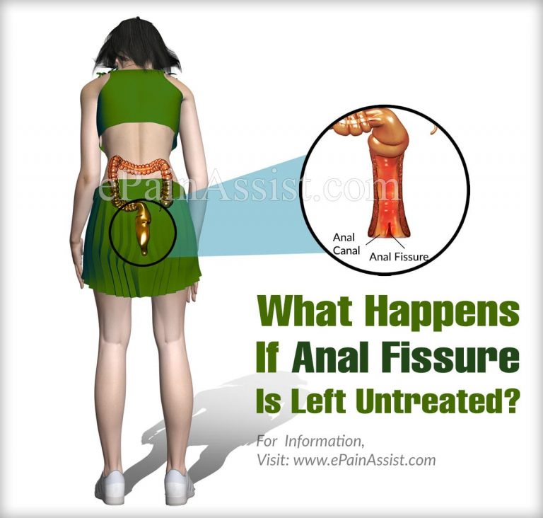 What Happens If Anal Fissure Is Left Untreated?
