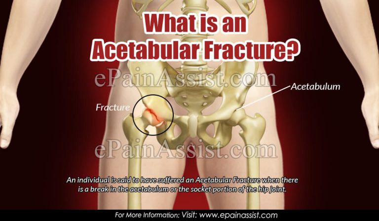 What is Acetabular Fracture & What is its Treatment, Recovery time and Classifications?