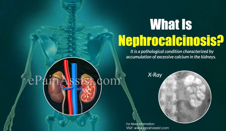 What is Nephrocalcinosis: Causes, Symptoms, Treatment