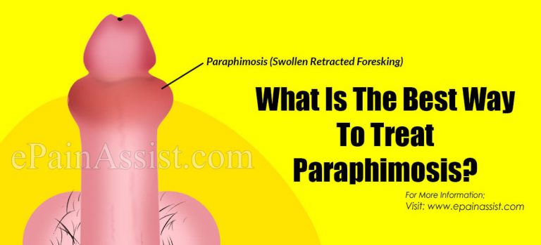 What Is The Best Way To Treat Paraphimosis?