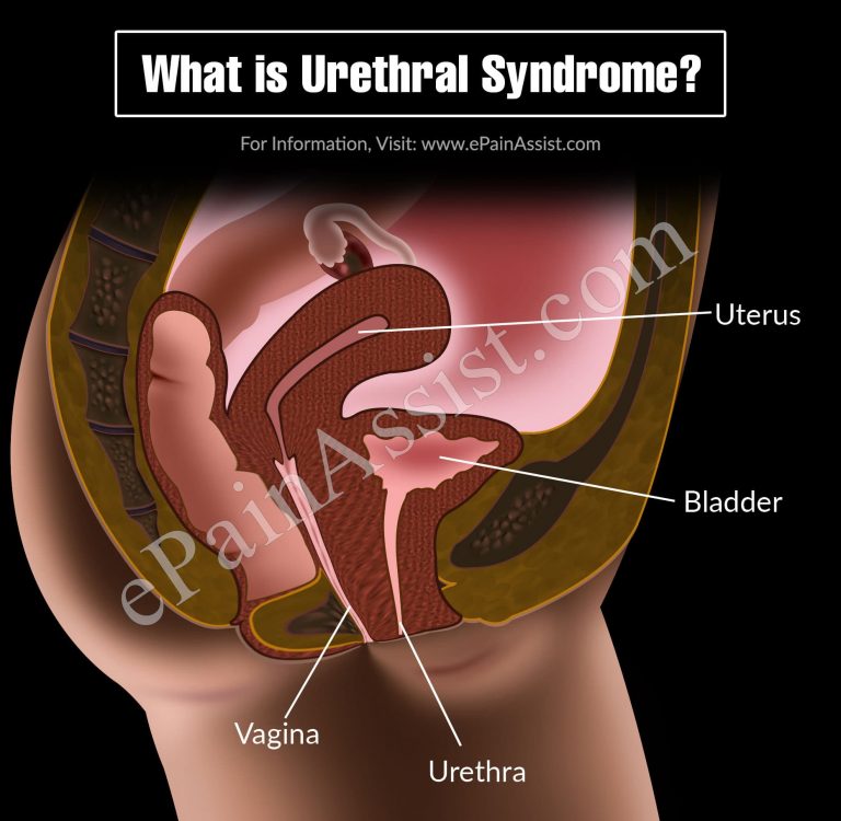 What Are The Presenting Features Of Urethral Syndrome & How is it Treated?