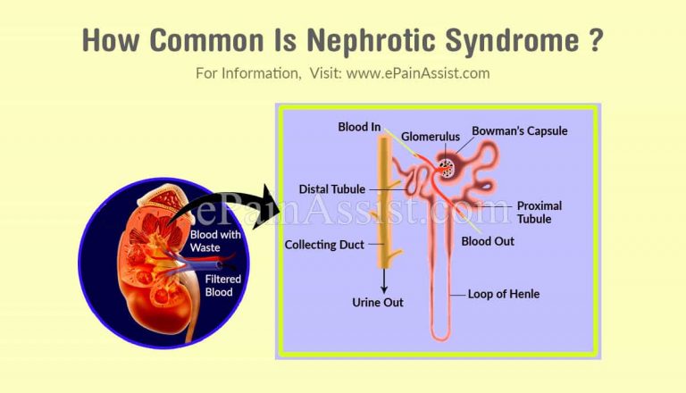 How Common Is Nephrotic Syndrome Or Is It Is A Rare Disease?