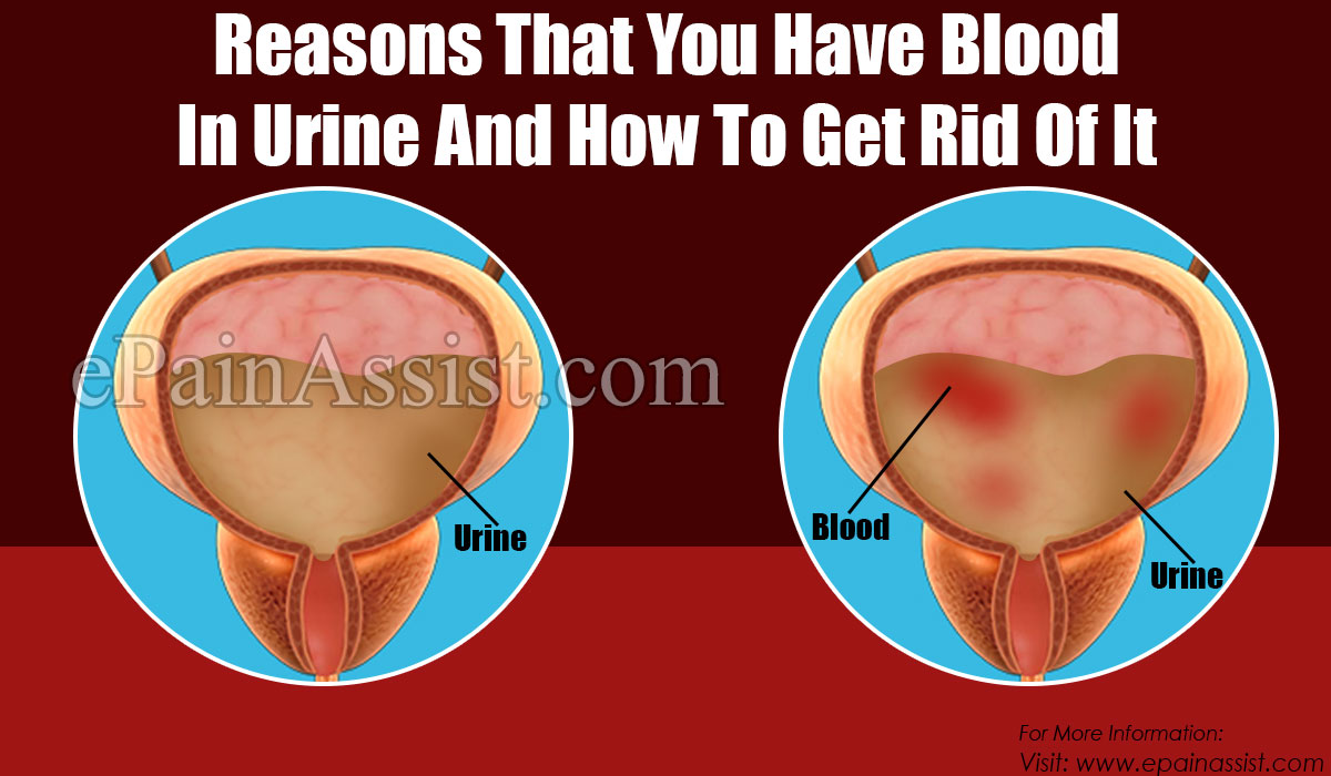 Reasons That You Have Blood In Urine And How To Get Rid Of It