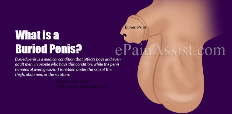 Is Buried Penis A Common Condition & How is it Treated?