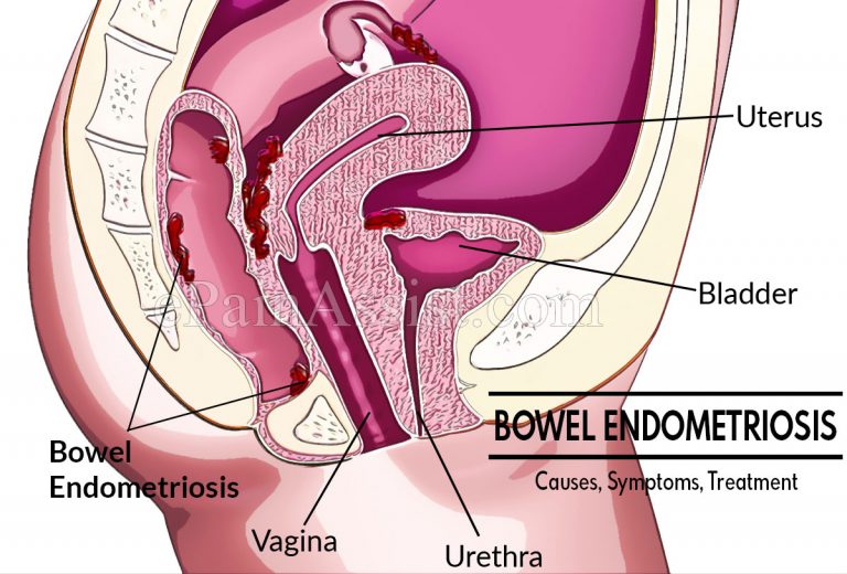 Bowel Endometriosis: Causes, Symptoms, Treatment, Diagnosis