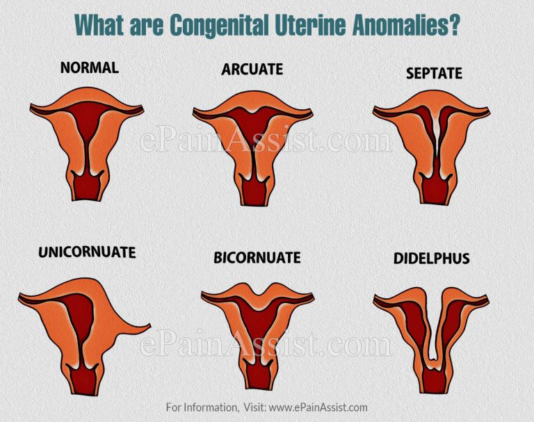 Congenital Uterine Anomalies – Their Impact On Fertility