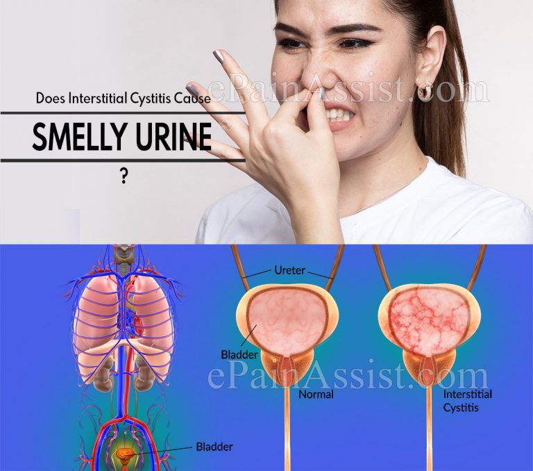 Does Interstitial Cystitis Cause Smelly Urine & Can A Urine Test Detect IC?