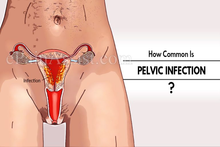 How Common Is Pelvic Infection Or Is It A Rare Disease?