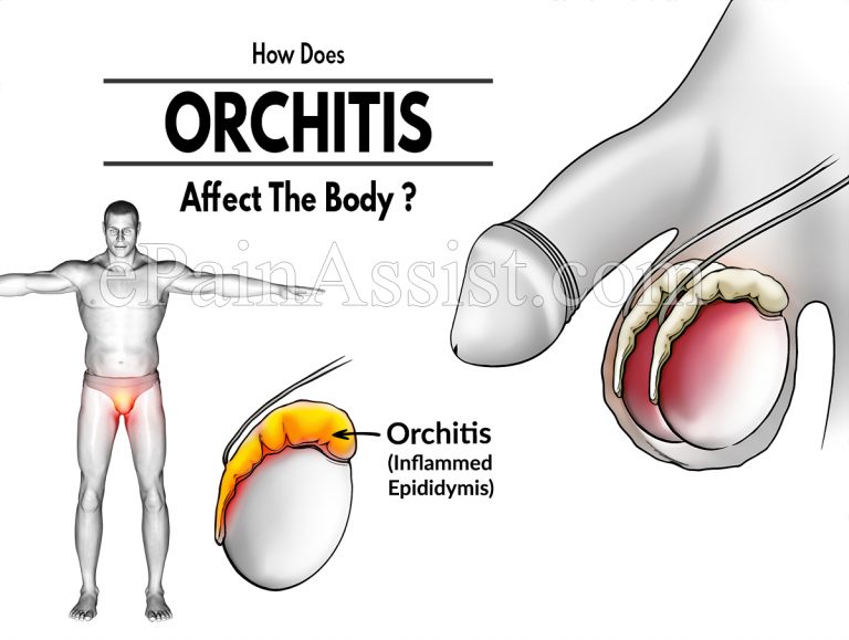 How Does Orchitis Affect The Body & What Triggers It?