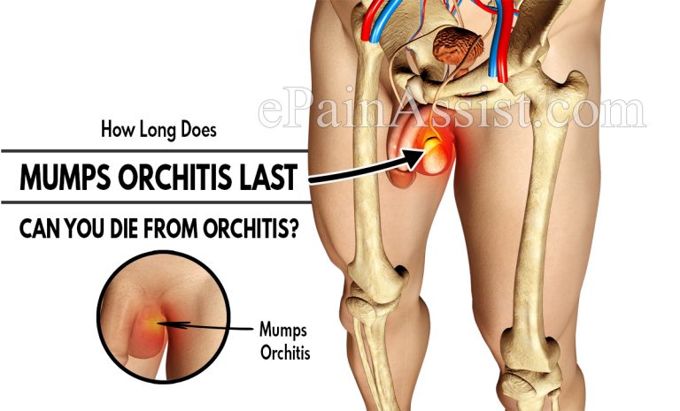 How Long Does Mumps Orchitis Last & Can You Die From Orchitis?