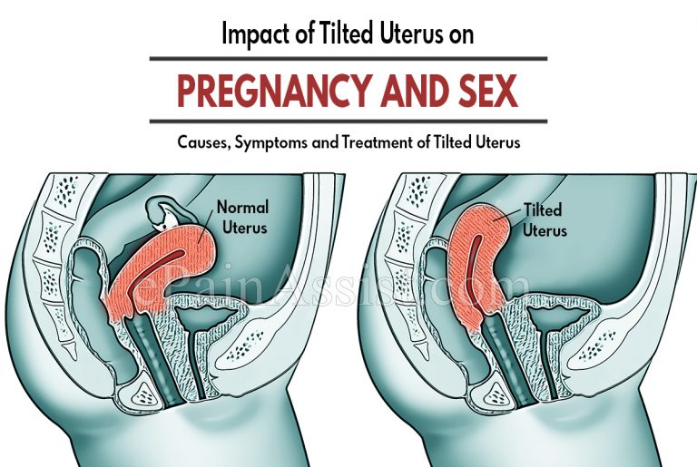 Impact of Tilted Uterus on Pregnancy and Sex | Causes, Symptoms and Treatment of Tilted Uterus