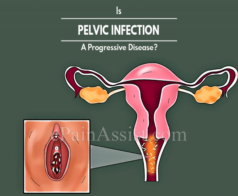 Is Pelvic Infection A Progressive Disease & Alternative Treatments For It?