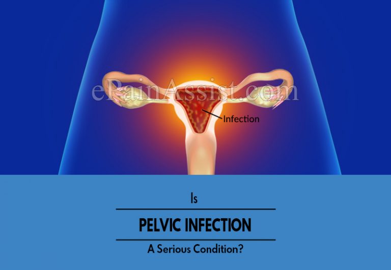 Is Pelvic Infection A Serious Condition & Can It Be Reversed?