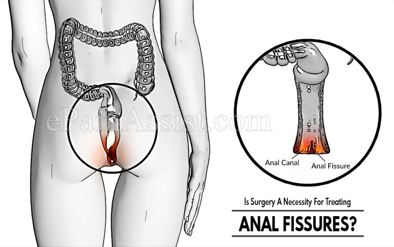 Is Surgery A Necessity For Treating Anal Fissures?