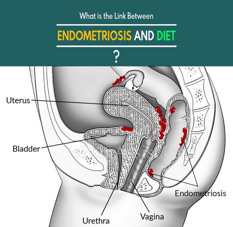 Link Between Endometriosis and Diet: What To Include In An Endometriosis Diet?