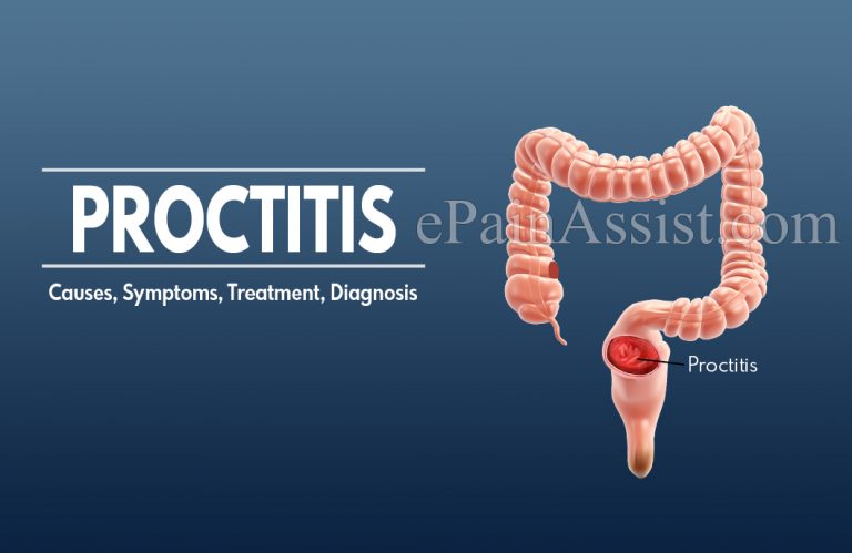 Proctitis: Causes, Symptoms, Treatment, Diagnosis