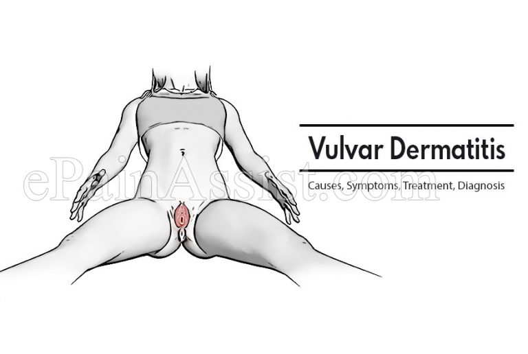Vulvar Dermatitis : Causes, Symptoms, Treatment, Diagnosis