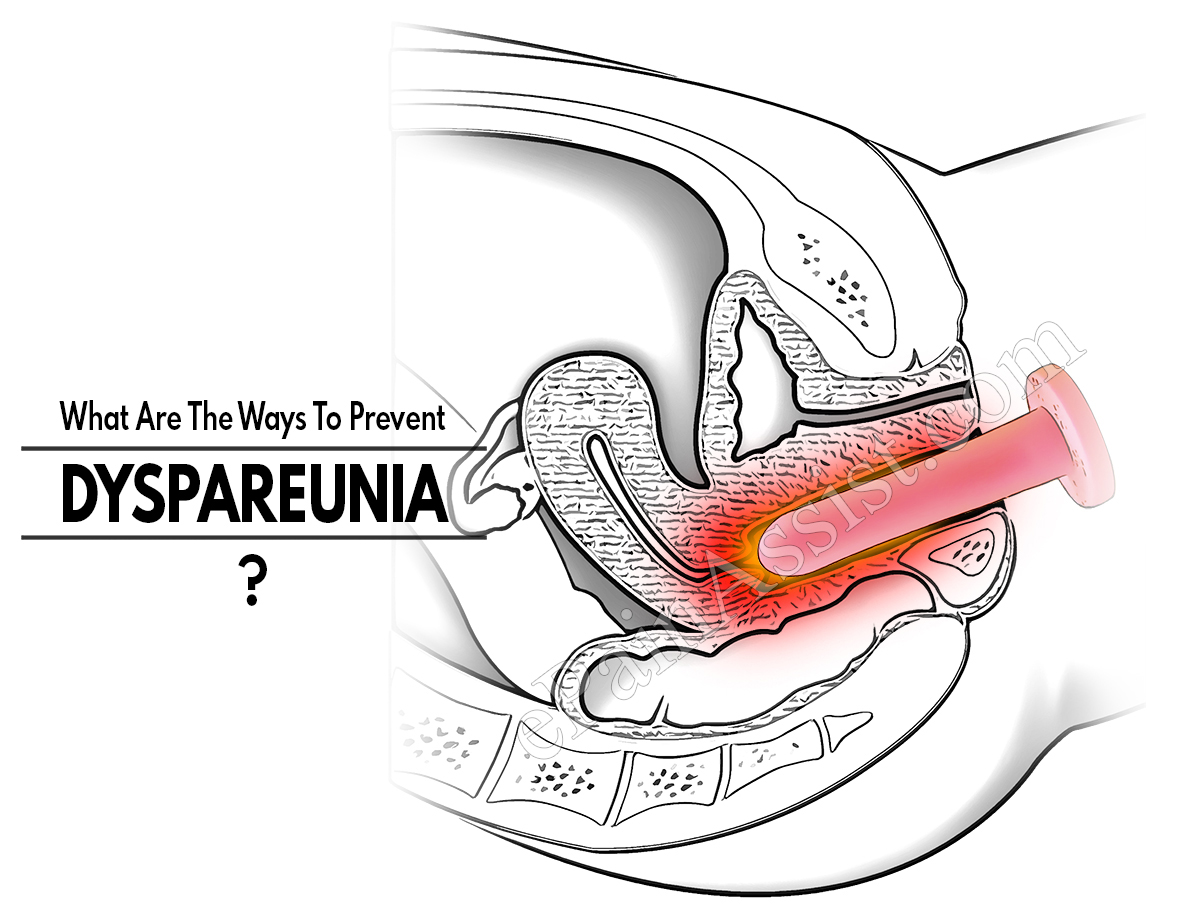 What Are The Ways To Prevent Dyspareunia?