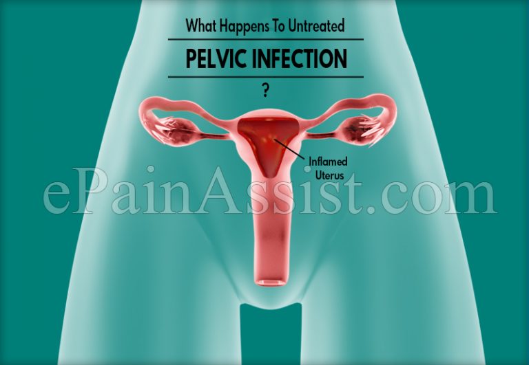 What Happens To Untreated Pelvic Infection & When To Go To The Doctor?