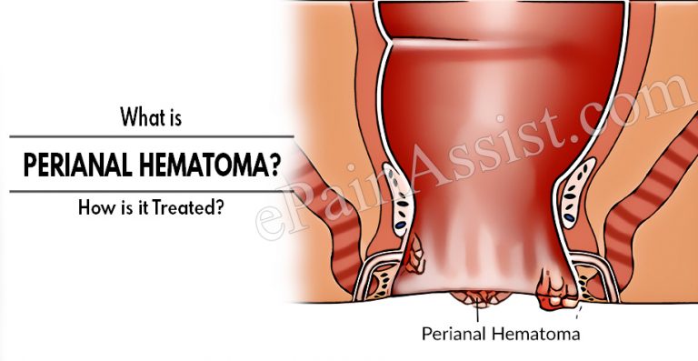 What is Perianal Hematoma & How is it Treated? | Causes & Symptoms of Perianal Hematoma