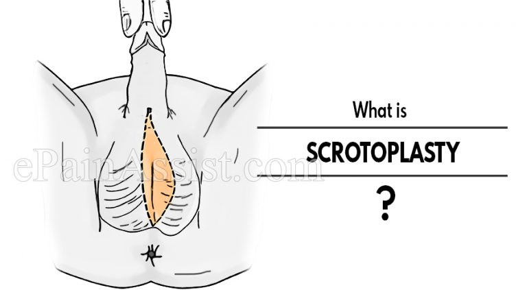 What is Scrotoplasty & Who Is An Ideal Candidate For Scrotoplasty?