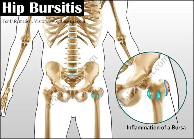 Hip Bursitis or Trochanteric Bursitis: Causes, Symptoms, Treatment, Exercises