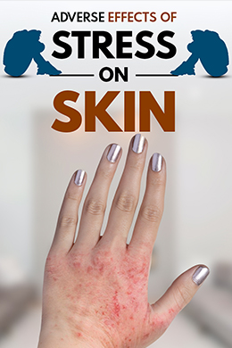 Adverse Effects of Stress on the Skin