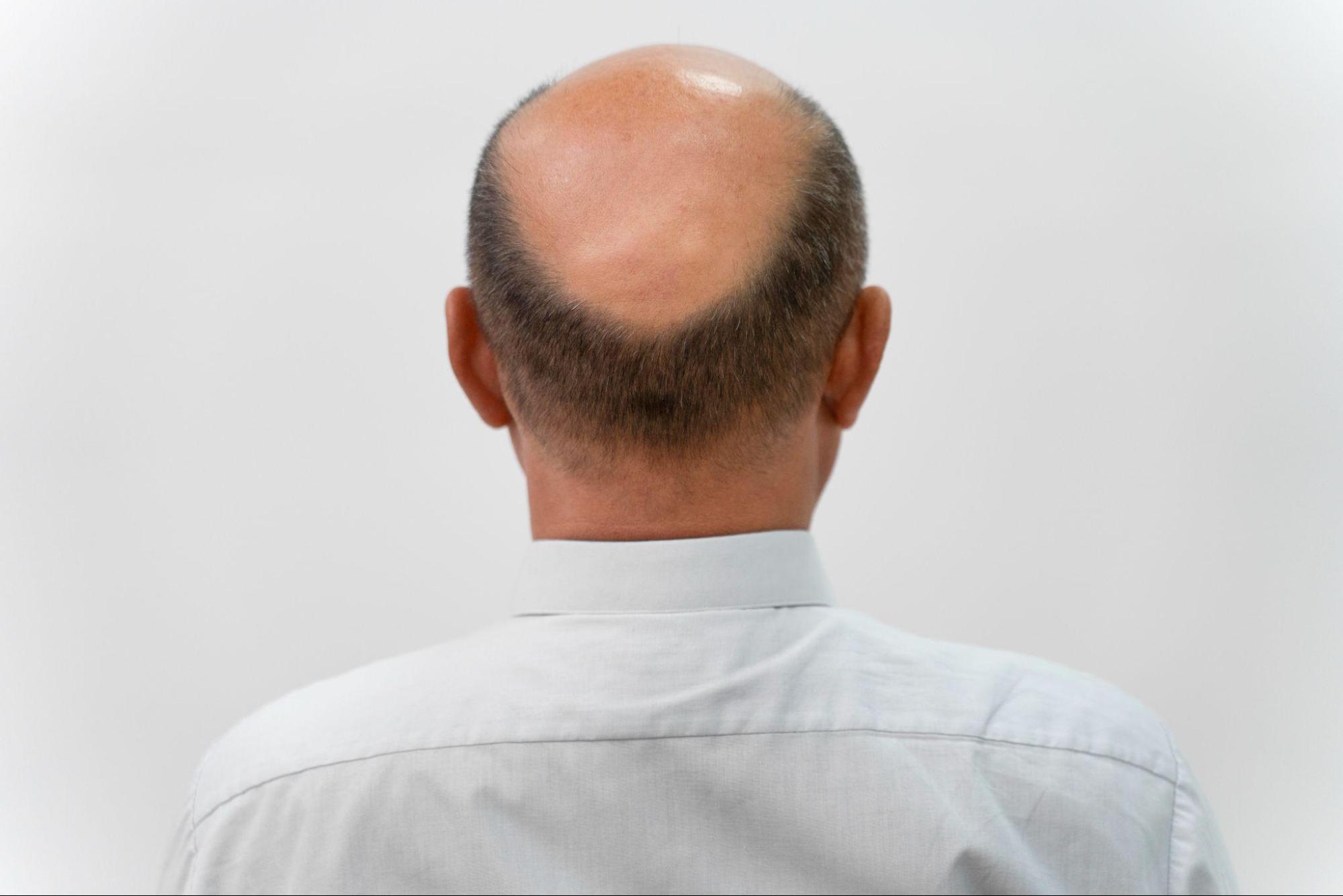 How a Single Hormone Drives Most Pattern Baldness Cases
