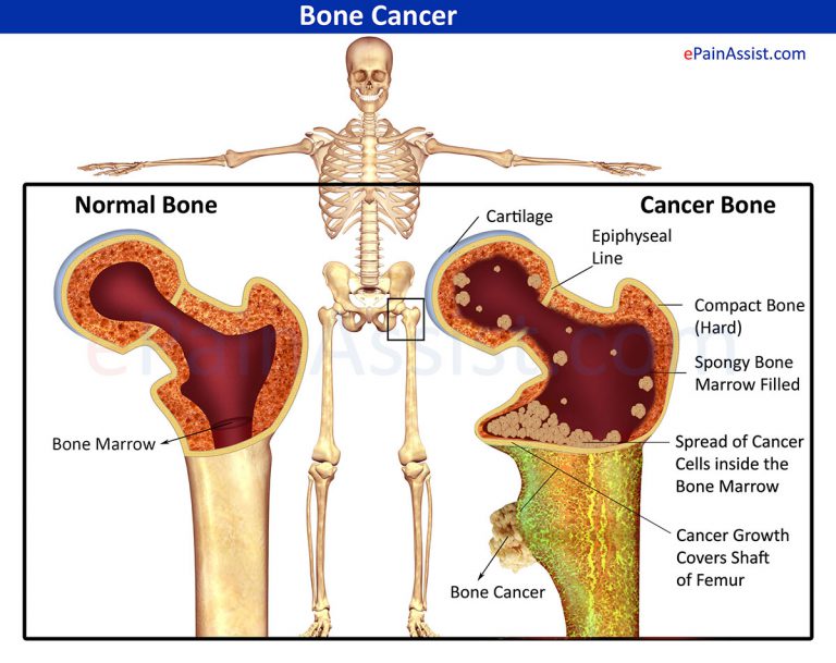 Bone Cancer: Types, Stages, Causes, Symptoms, Treatment- Surgery, Radiation, Chemotherapy