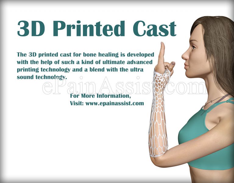 3D Printed Cast: Detailed Study, Development Process, Benefits, Conclusion