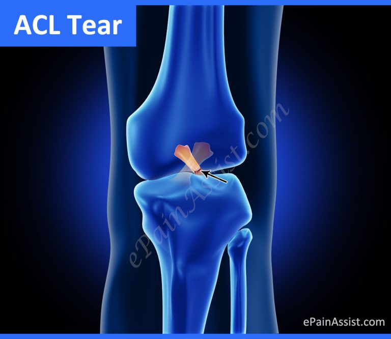 What is an ACL Tear and What are its Signs and Symptoms?