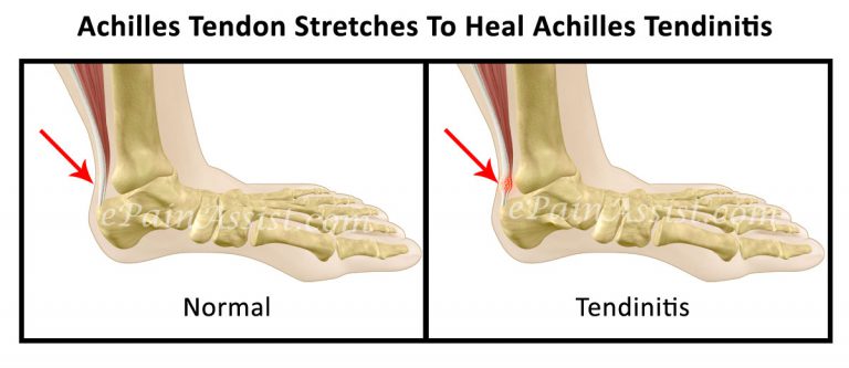 Achilles Tendon Stretches To Heal Achilles Tendinitis