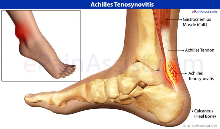 Achilles Tenosynovitis or Paratenonitis: Causes, Symptoms, Treatment, Recovery Time, Exercises