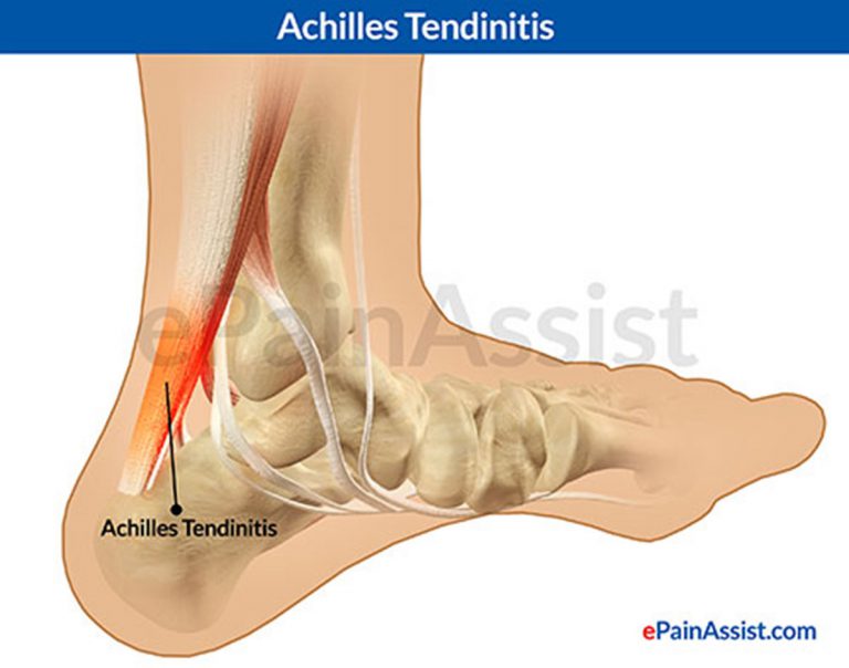 Achilles Tendinitis: Causes, Symptoms, Treatment- Ice, Heel Pads, Manual Therapy