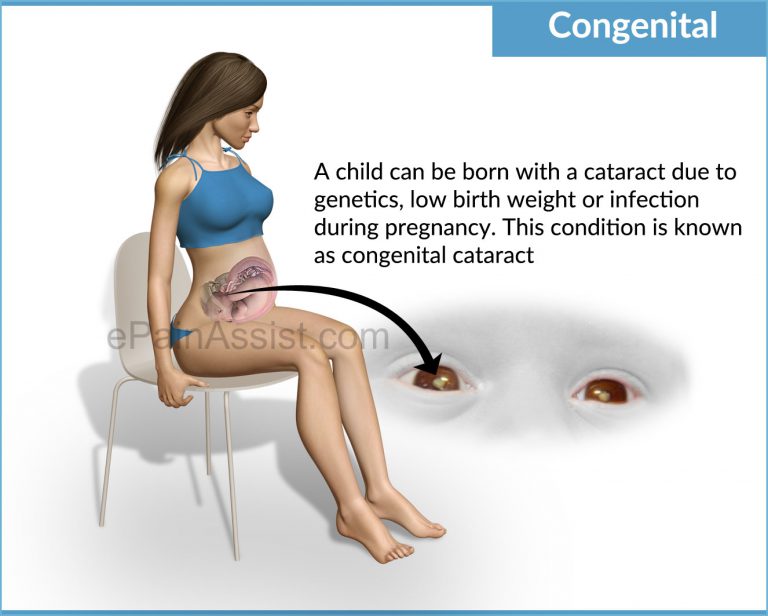 Congenital or Acquired Cataracts in Children