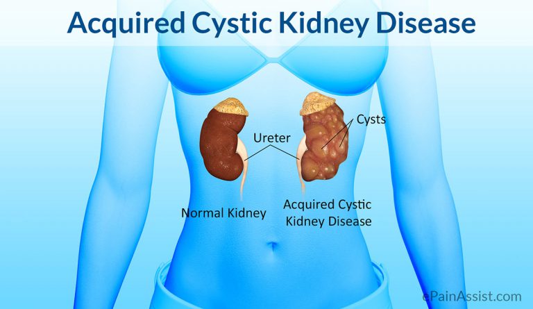 Acquired Cystic Kidney Disease (ACKD): Causes, Symptoms, Diagnosis, Treatment