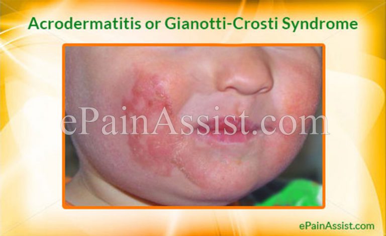 Acrodermatitis or Gianotti-Crosti Syndrome: Causes, Signs, Symptoms, Investigations, Treatment